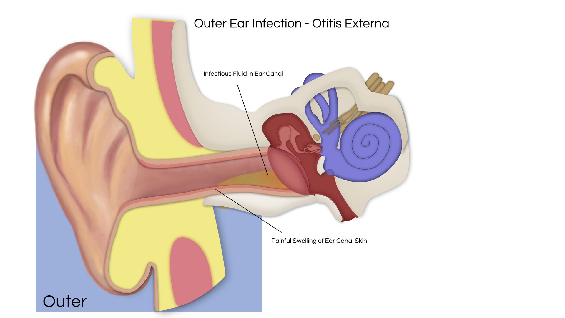 Hammer, Anvil & Stirrup by otoscopy. Bones of the middle ear