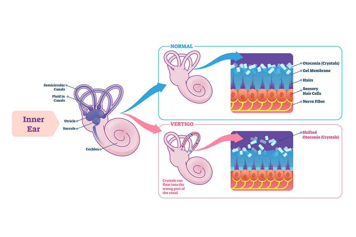 Can Menstrual Cycles Cause Vertigo?